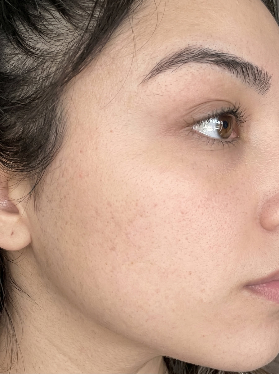 Before - Acne & Breakouts