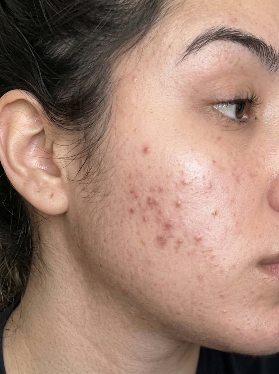 After - Acne & Breakouts