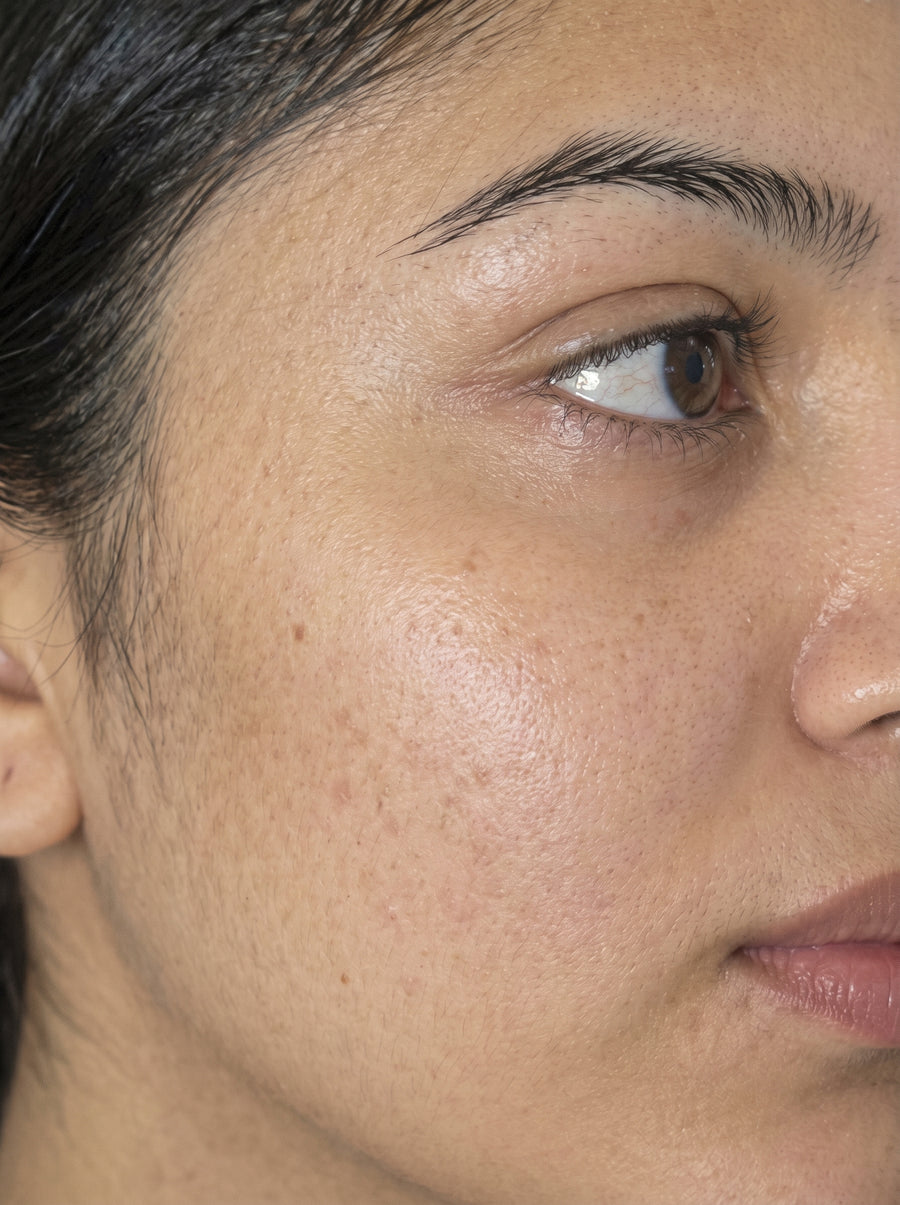 After - Sun Damage & Dark Spots