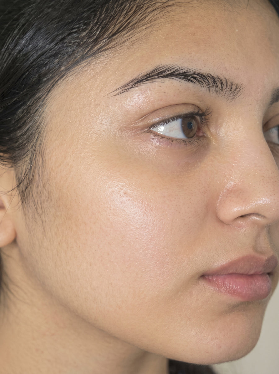 Before - Sun Damage & Dark Spots